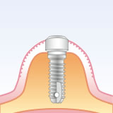 入れ歯による治療